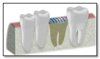 Bone Grafting to allow for healthy bone to place dental implant