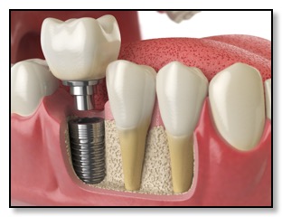 dental implant crown and abutment healed and restored