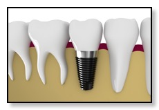 example of a dental implant cross-section of the jaw bone