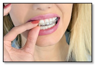 bruxism night guard easy to use and wear