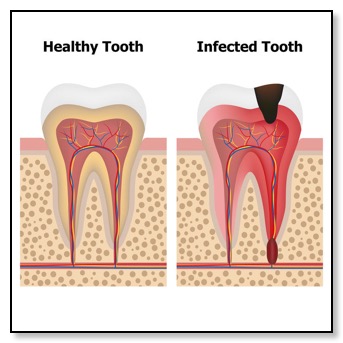 Healthy and infecgted tooth diagram