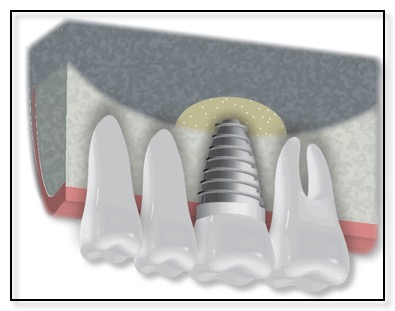 Bone Graft and Sinus Lift for Dental Implants at Millbrae Dental