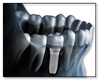 Z-SYSTEMS All Ceramic Dental Implants - Metal Free 